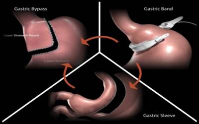 lap band surgery20180320161631_l